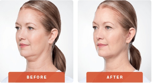 Kybella-Before-After