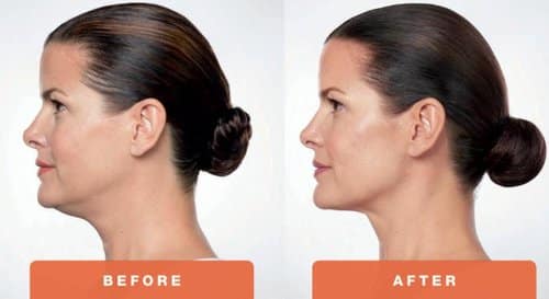Kybella-Treatment-Before-and-After-Photo