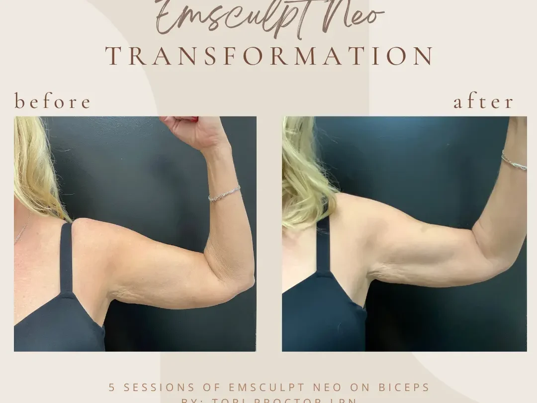 Emsculpt NEO at Bella Med Spa