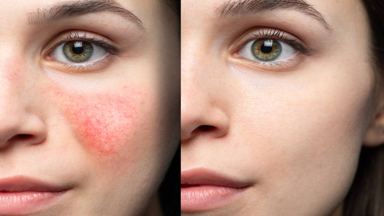How Often to Get Laser for Broken Capillaries on Face? 