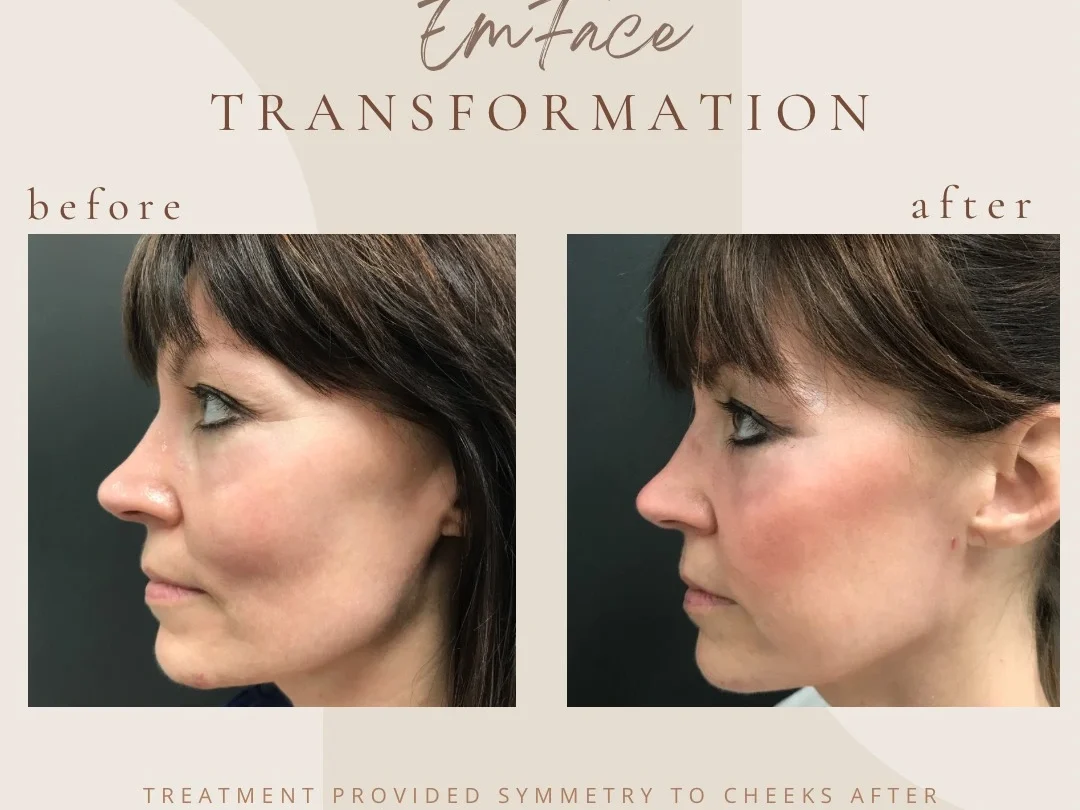 Facial Rejuvenation with Emface at Bella Med Spa