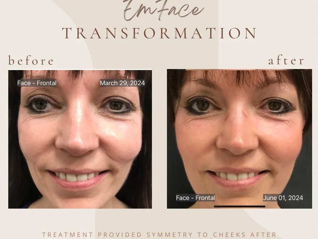 Facial Rejuvenation with Emface at Bella Med Spa