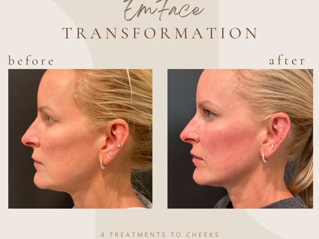 Facial Rejuvenation with Emface at Bella Med Spa