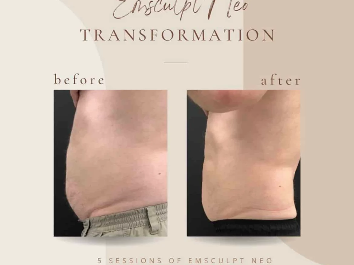 Emsculpt neo at Bella Med Spa