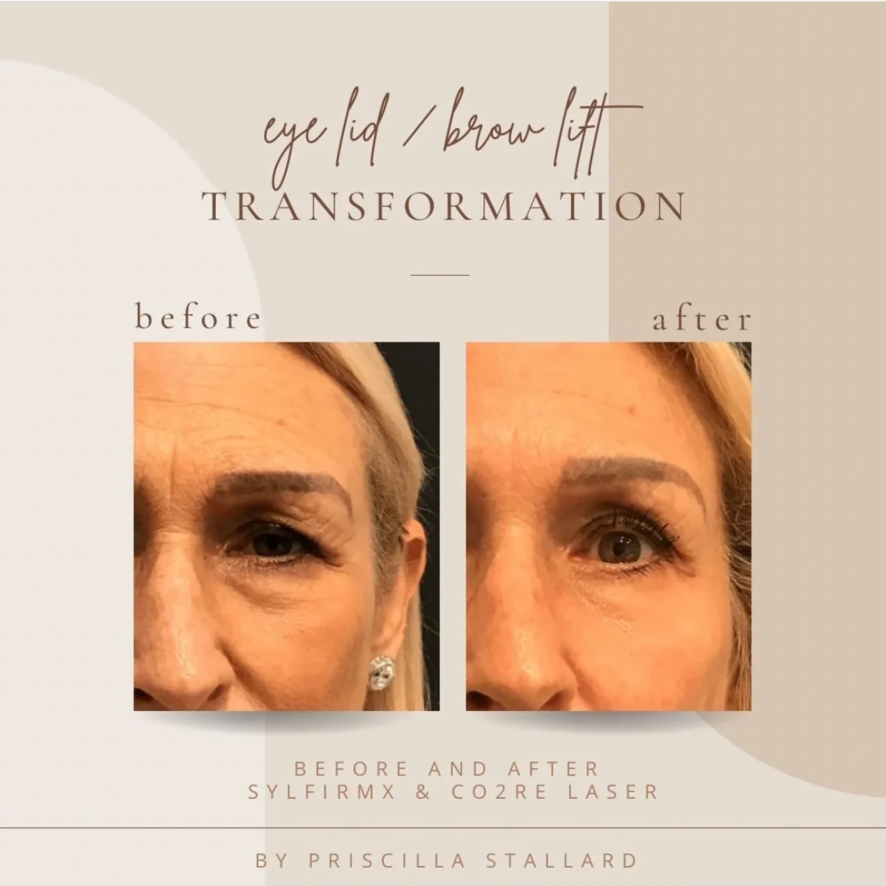 Co2re Laser Resurfacing at Bella Med Spa