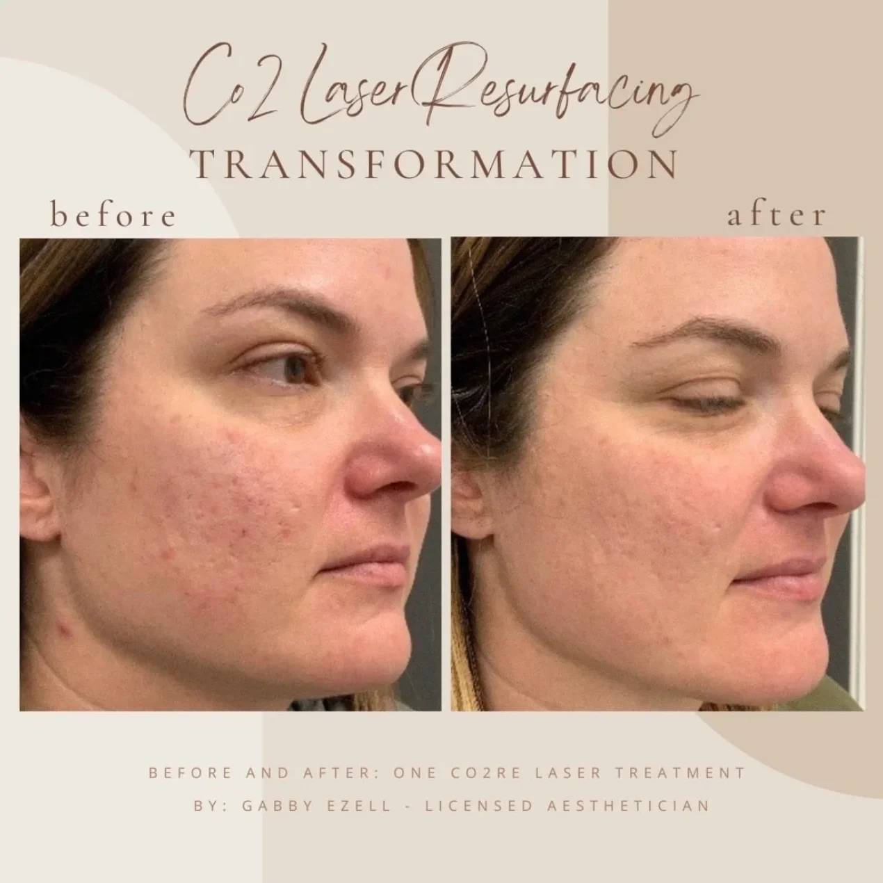 Co2re Laser Resurfacing at Bella Med Spa
