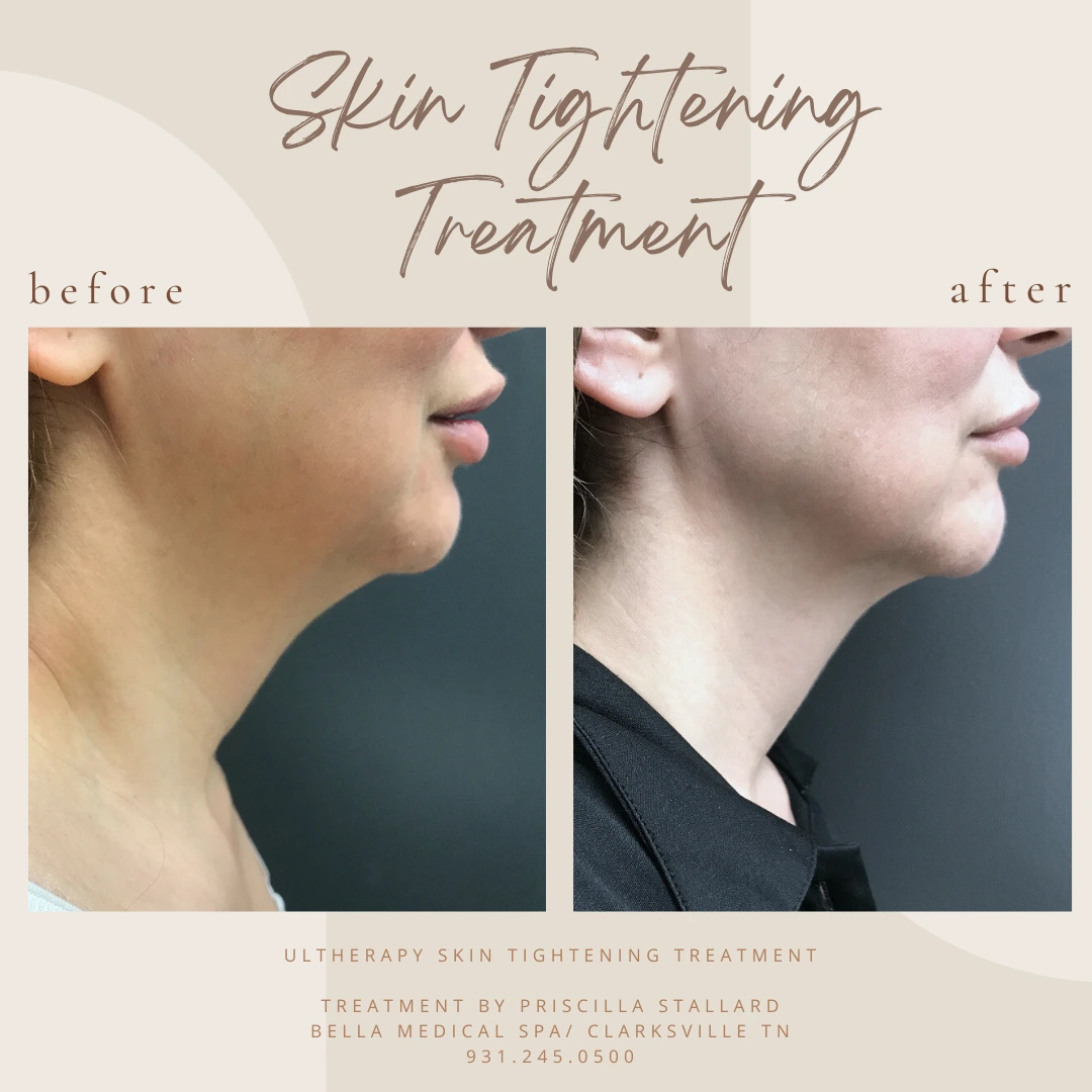 Skin Tightening with Ultherapy in Clarksville, TN at Bella Medical Spa