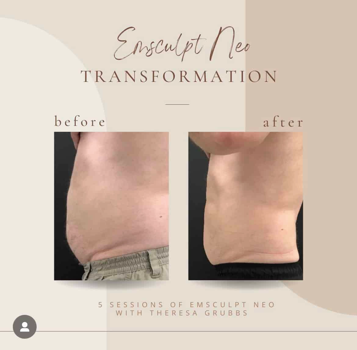 Emsculpt NEO in Clarksville, TN at Bella Medical Spa