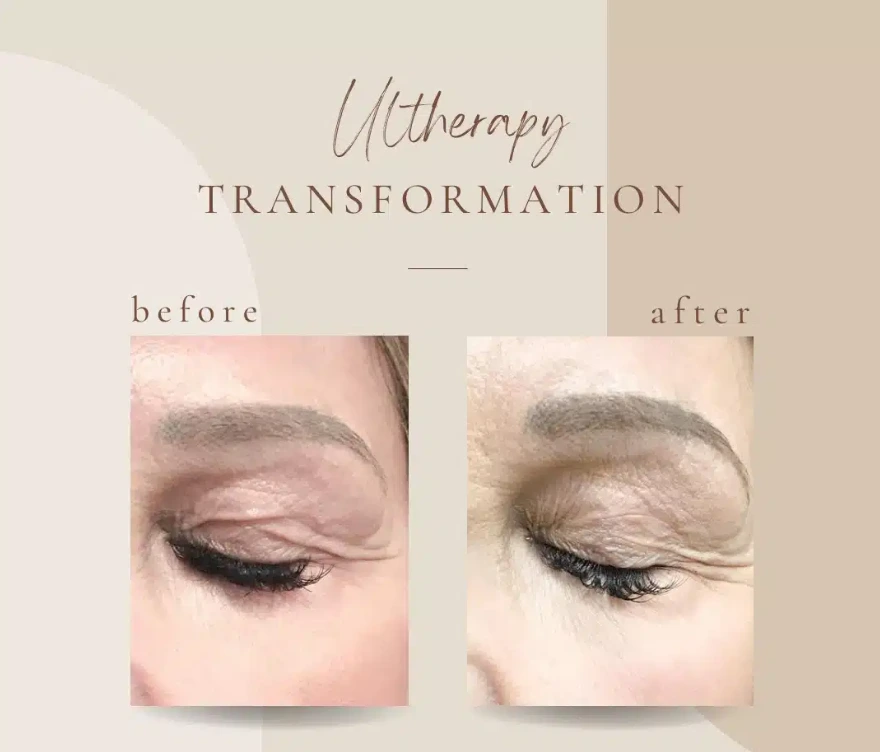 Skin Tightening with Ultherapy in Clarksville, TN at Bella Medical Spa