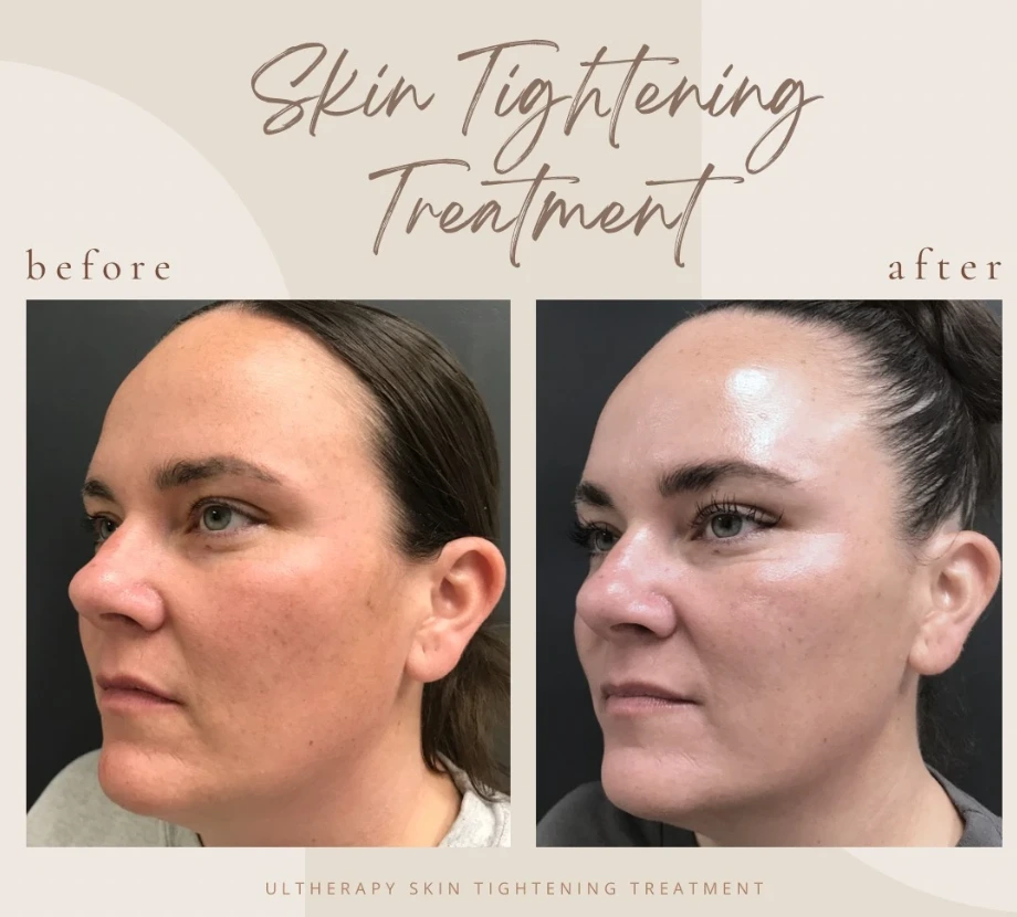 Skin Tightening with Ultherapy in Clarksville, TN at Bella Medical Spa
