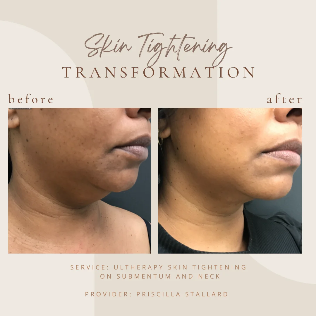 Skin Tightening-E in Clarksville, TN in-Clarksville-Tn