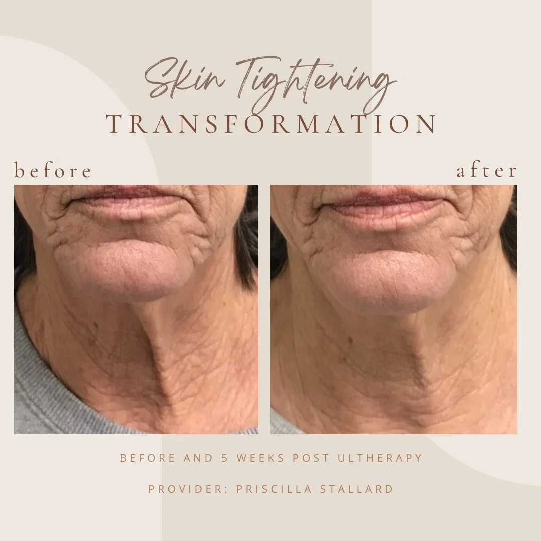 Skin Tightening in Clarksville, TN at Bella Medical Spain-Clarksville-Tn