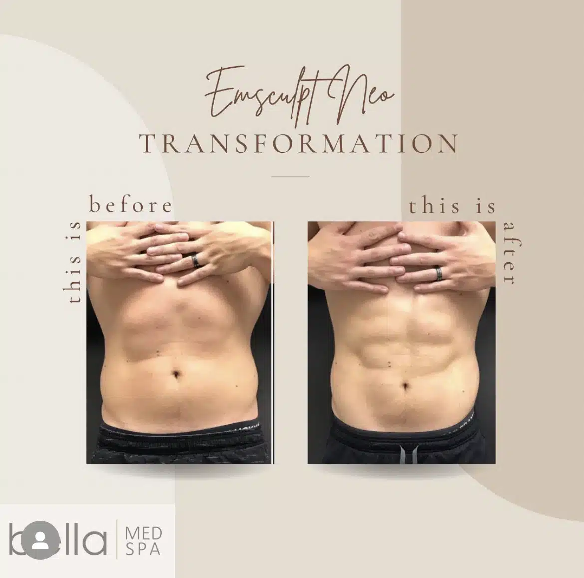 Emsculpt NEO in Clarksville, TN at Bella Medical Spa
