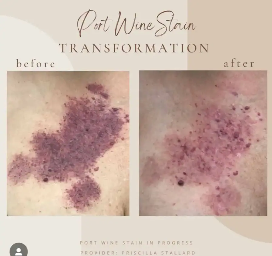 V- Beam Laser Redness and Rosacea Treatments