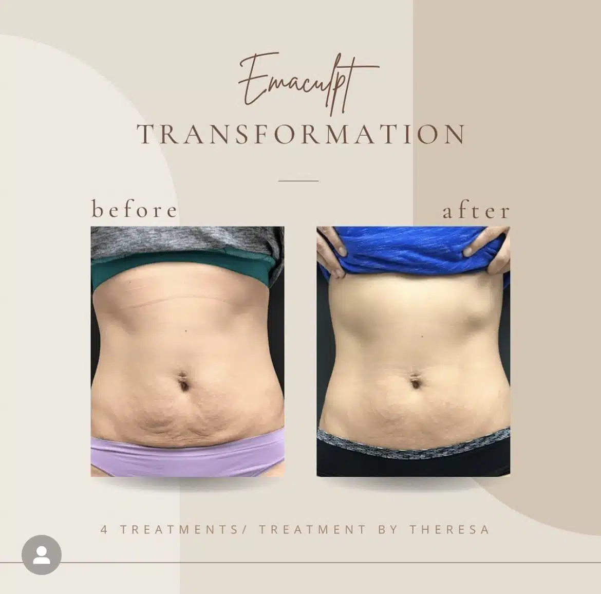 Before and after results showing improved skin tightness and reduced abdominal fat after four body contouring treatments at Bella Medspa.