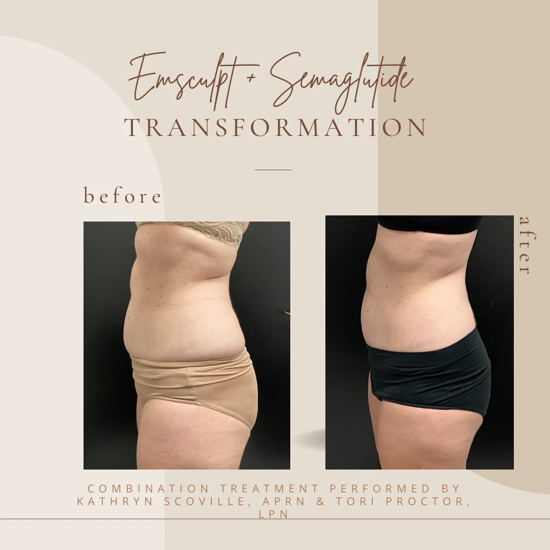 Emsculpt NEO in Clarksville, TN at Bella Medical Spa