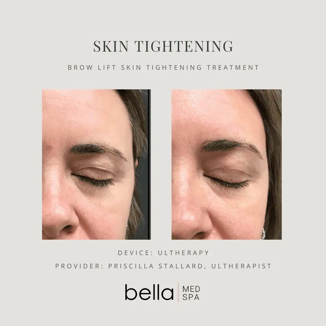 skin-tightaning-Din-Clarksville-Tn