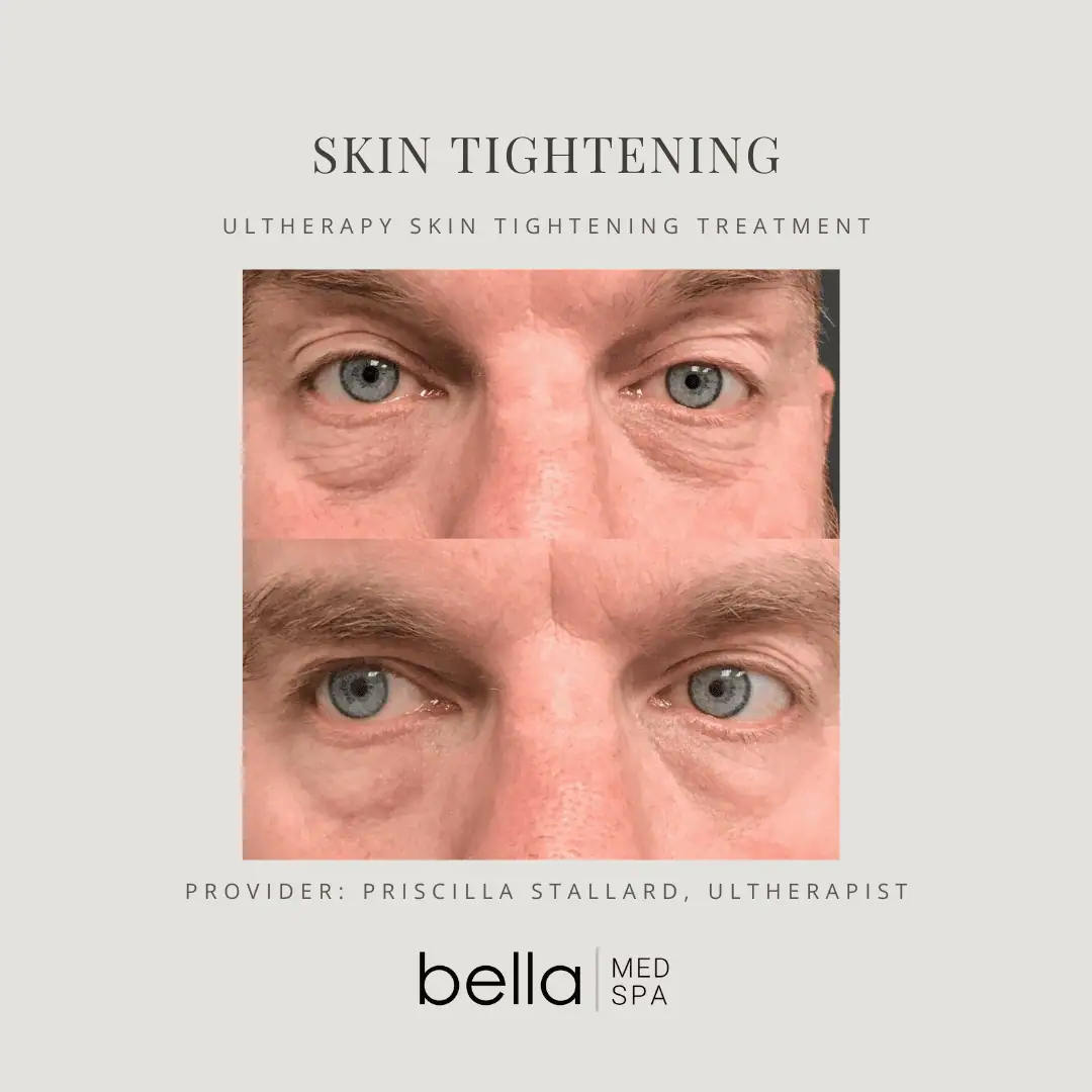 skin-tighttening-Cin-Clarksville-Tn