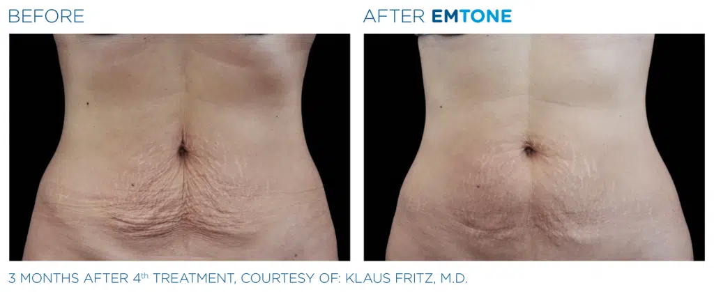 Emtone Treatment in Clarksville TN at Bella Med Spa