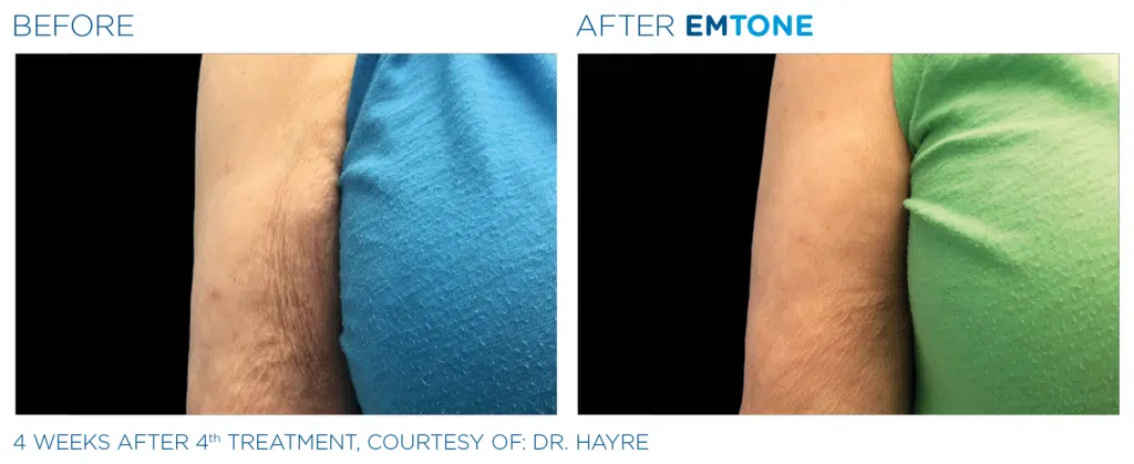 Emtone Treatment in Clarksville TN at Bella Med Spa