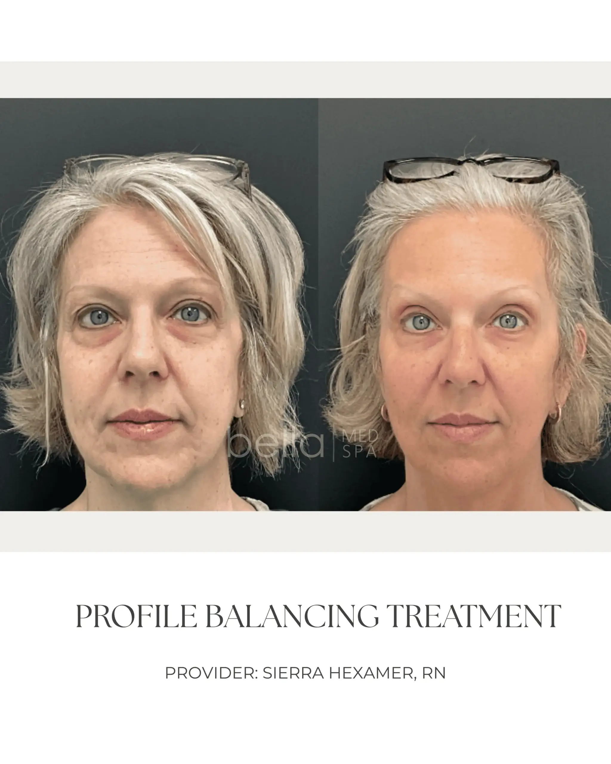 Profile Balancing Treatment