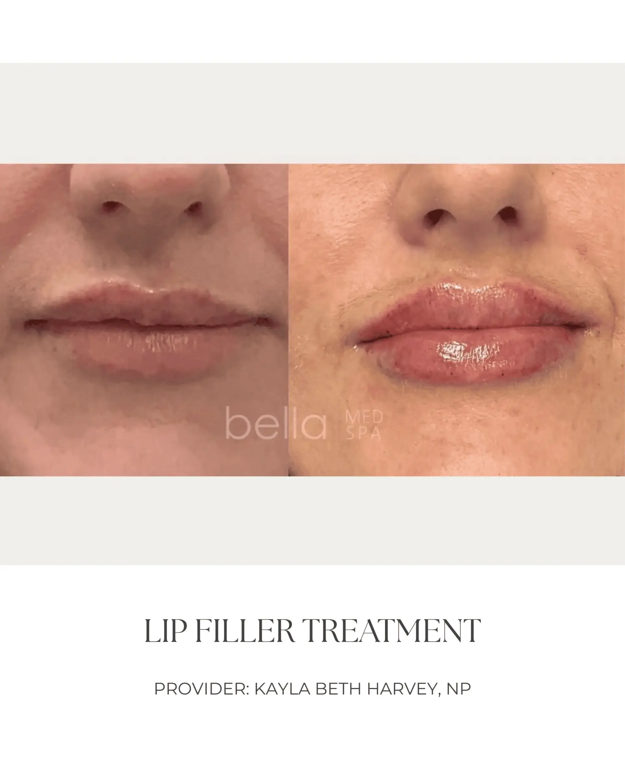 Lip Filler Transformation