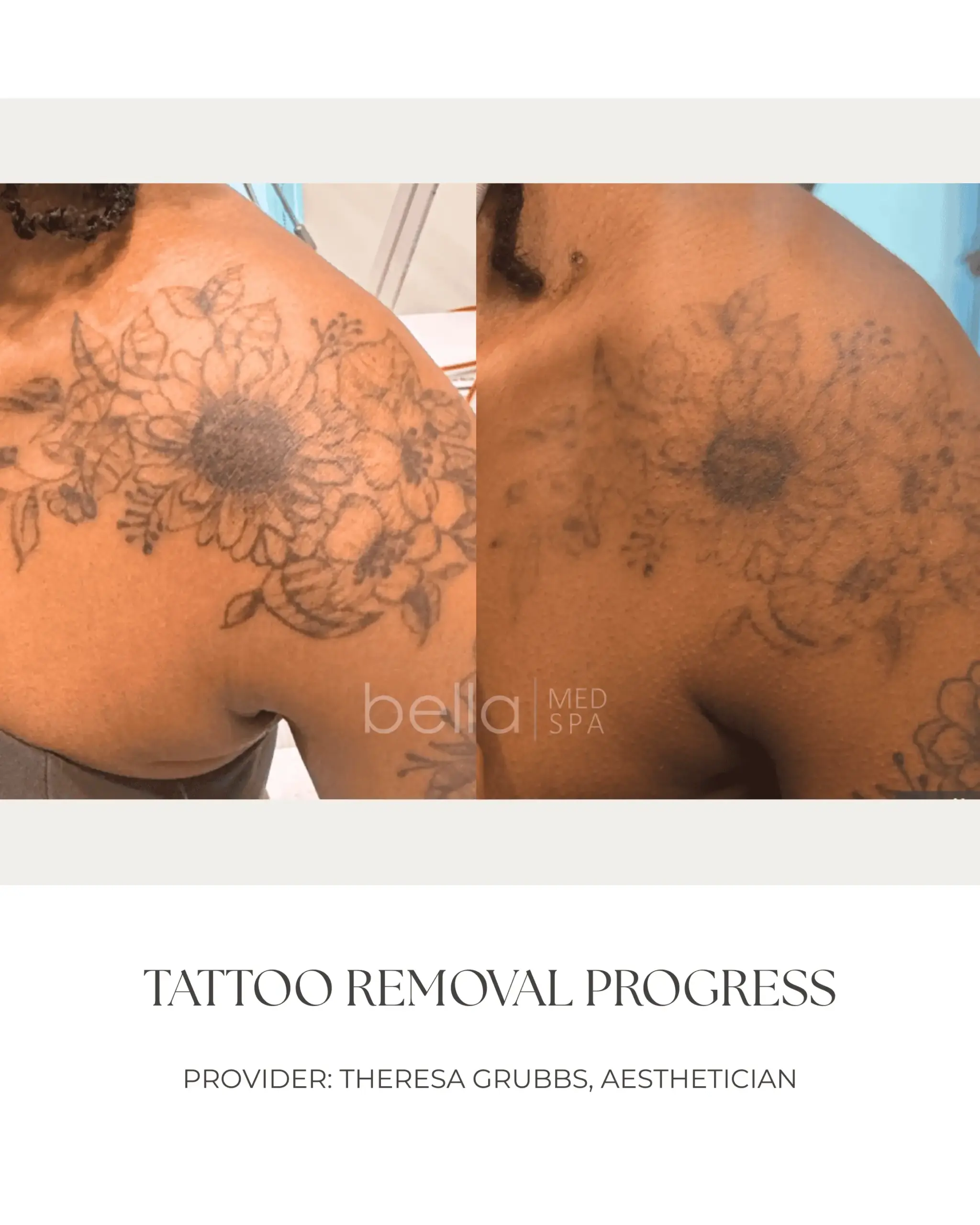 Tattoo Removal Progress