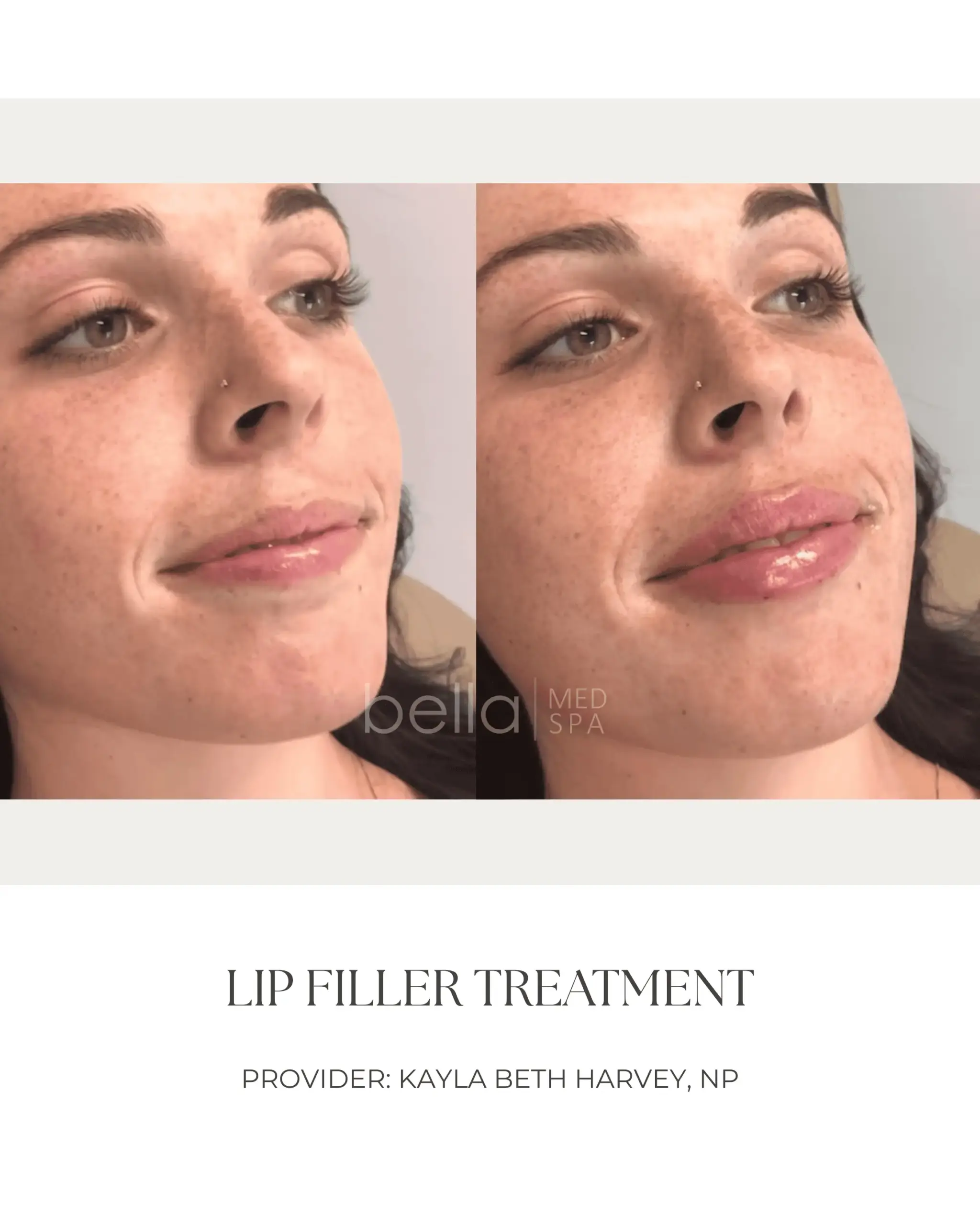 Lip Filler Transformation