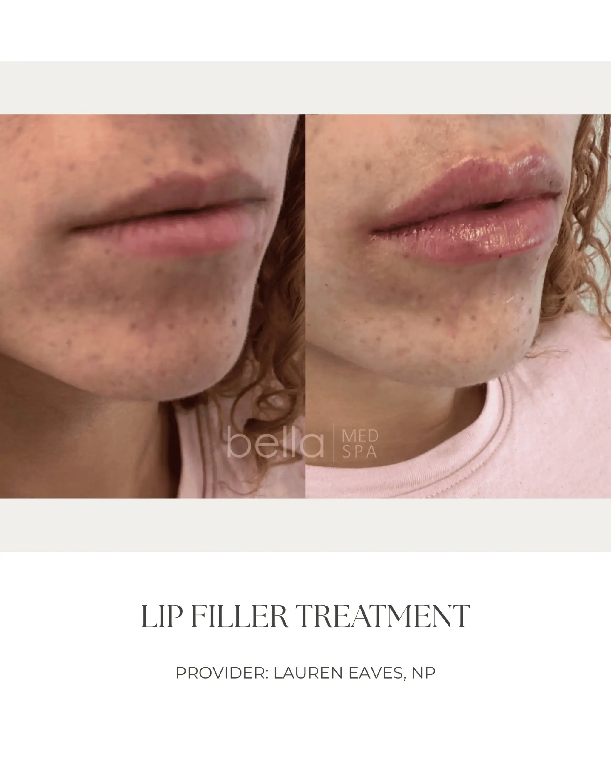 Lip Filler Transformation