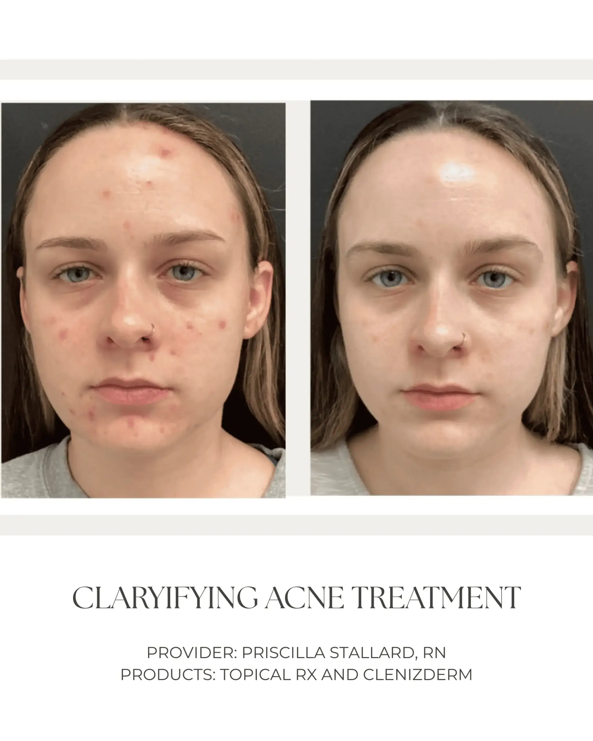 Claryifying Acne Treatment