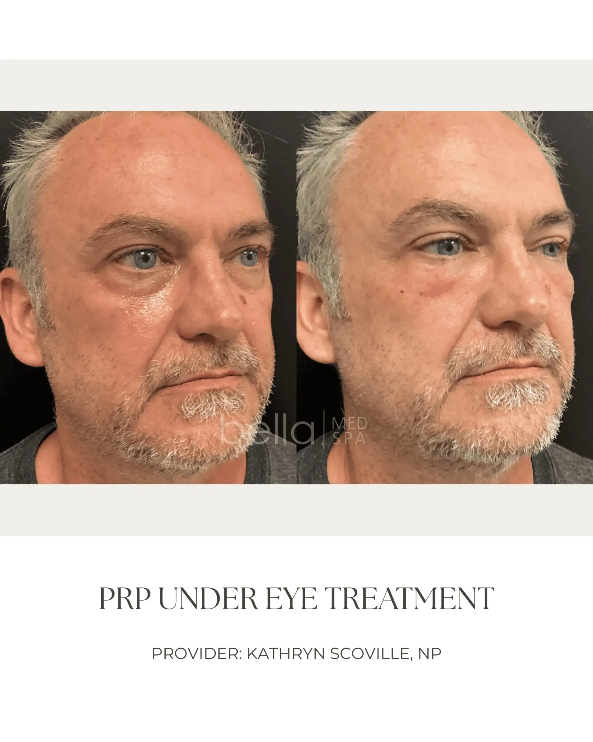 PRP Under Eye Treatment