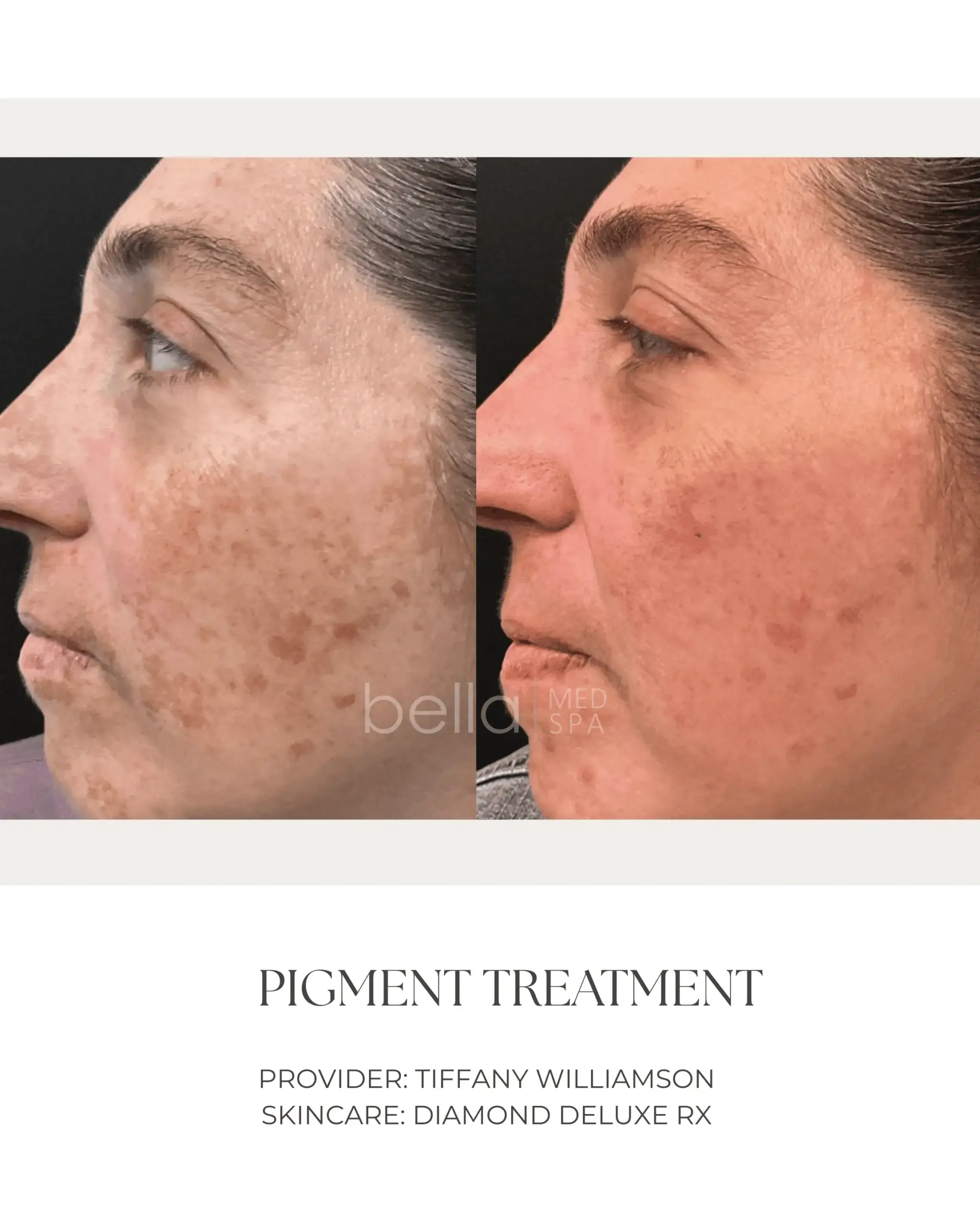 Pigment Treatment