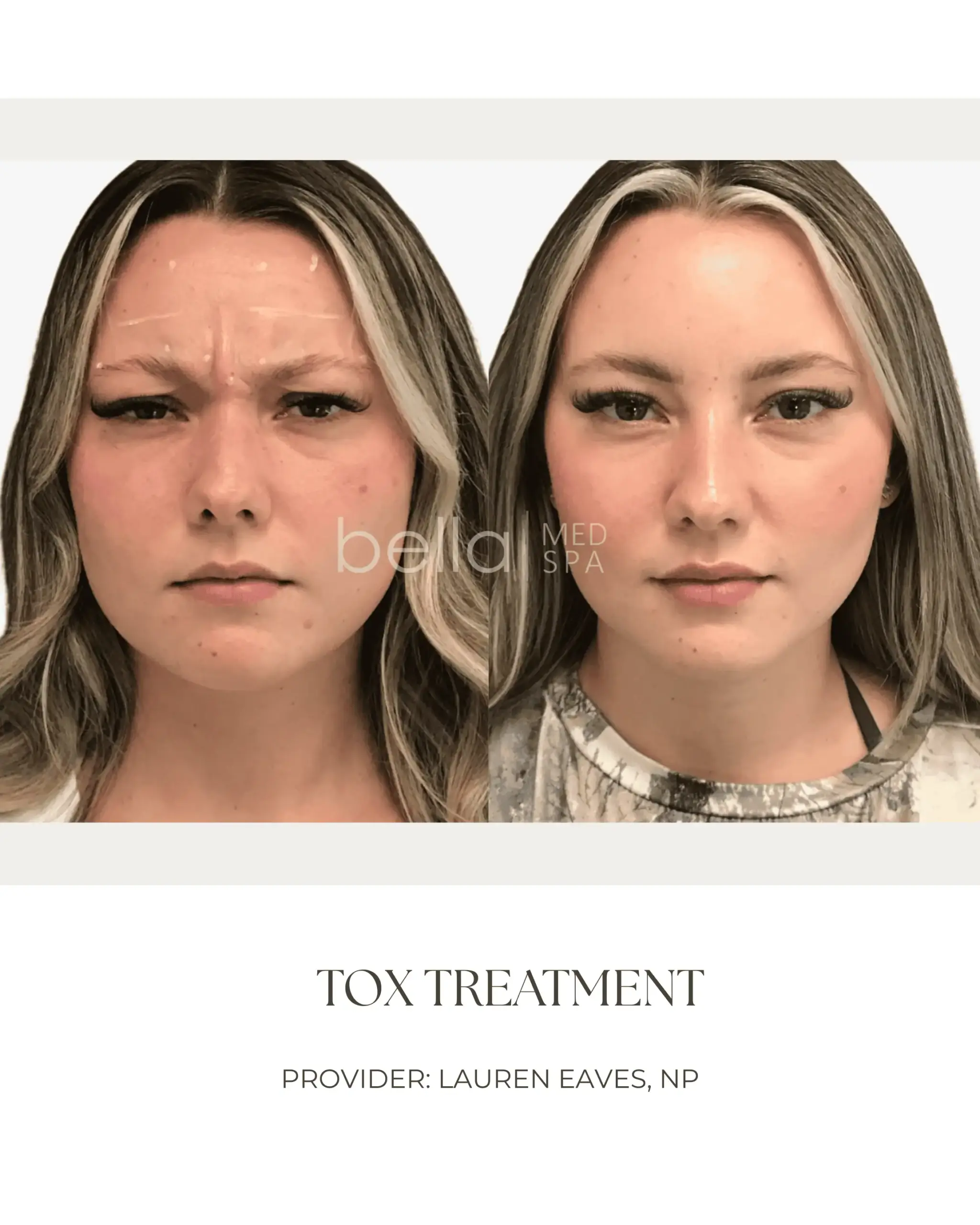 TOX Treatment