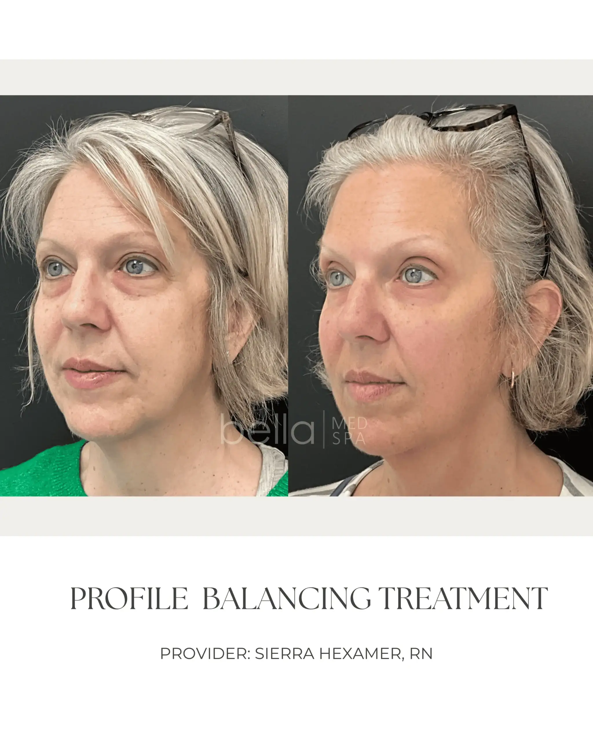Filler Transformation