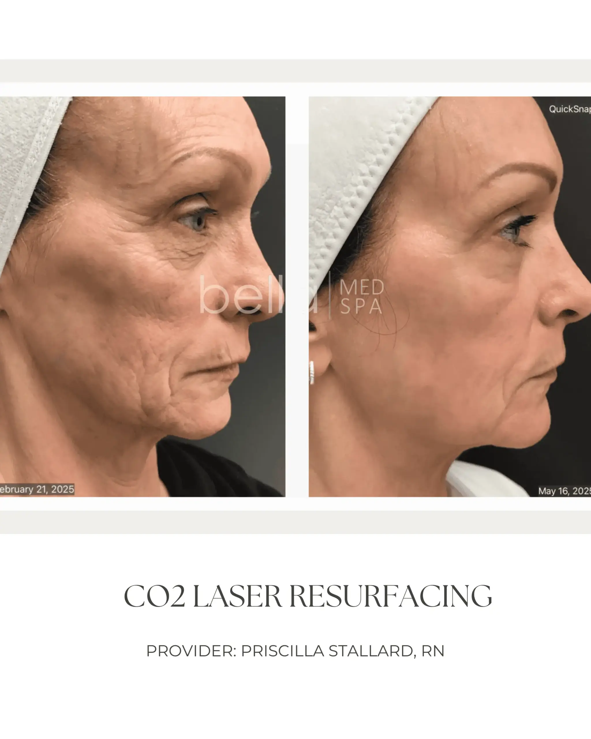 CO2 Laser Resurfacing