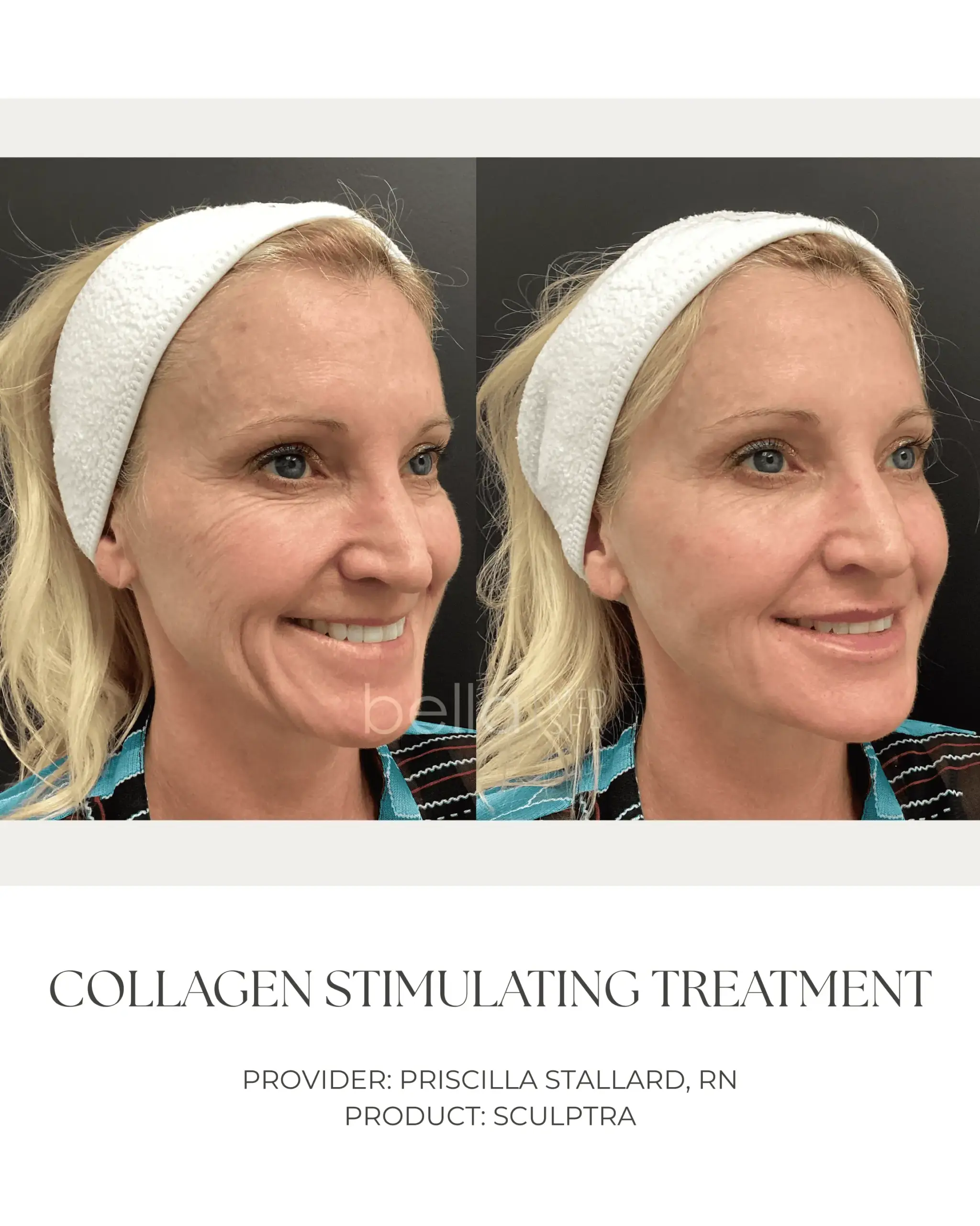 Collagen Stimulating Treatment