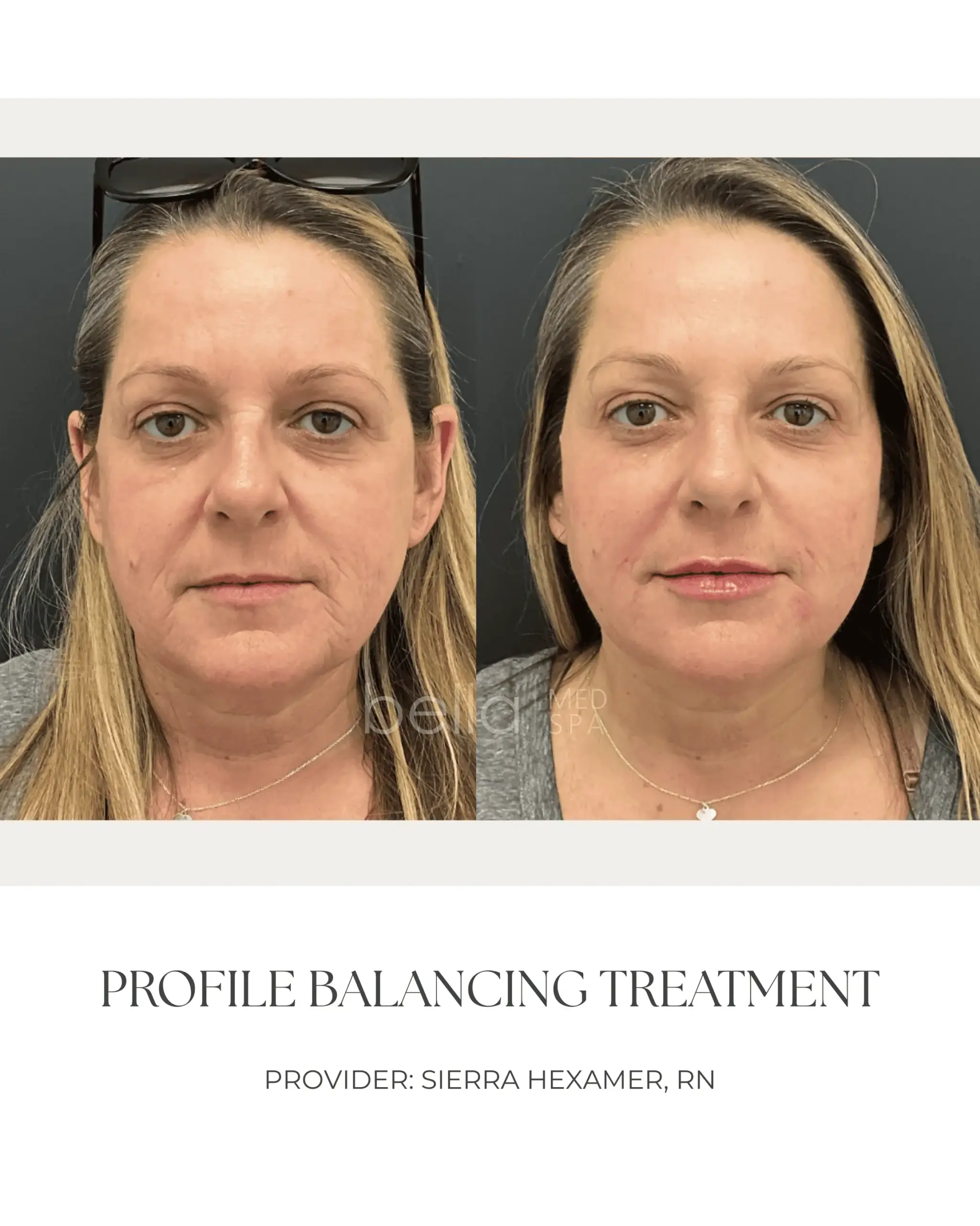 Profile Balancing Treatment