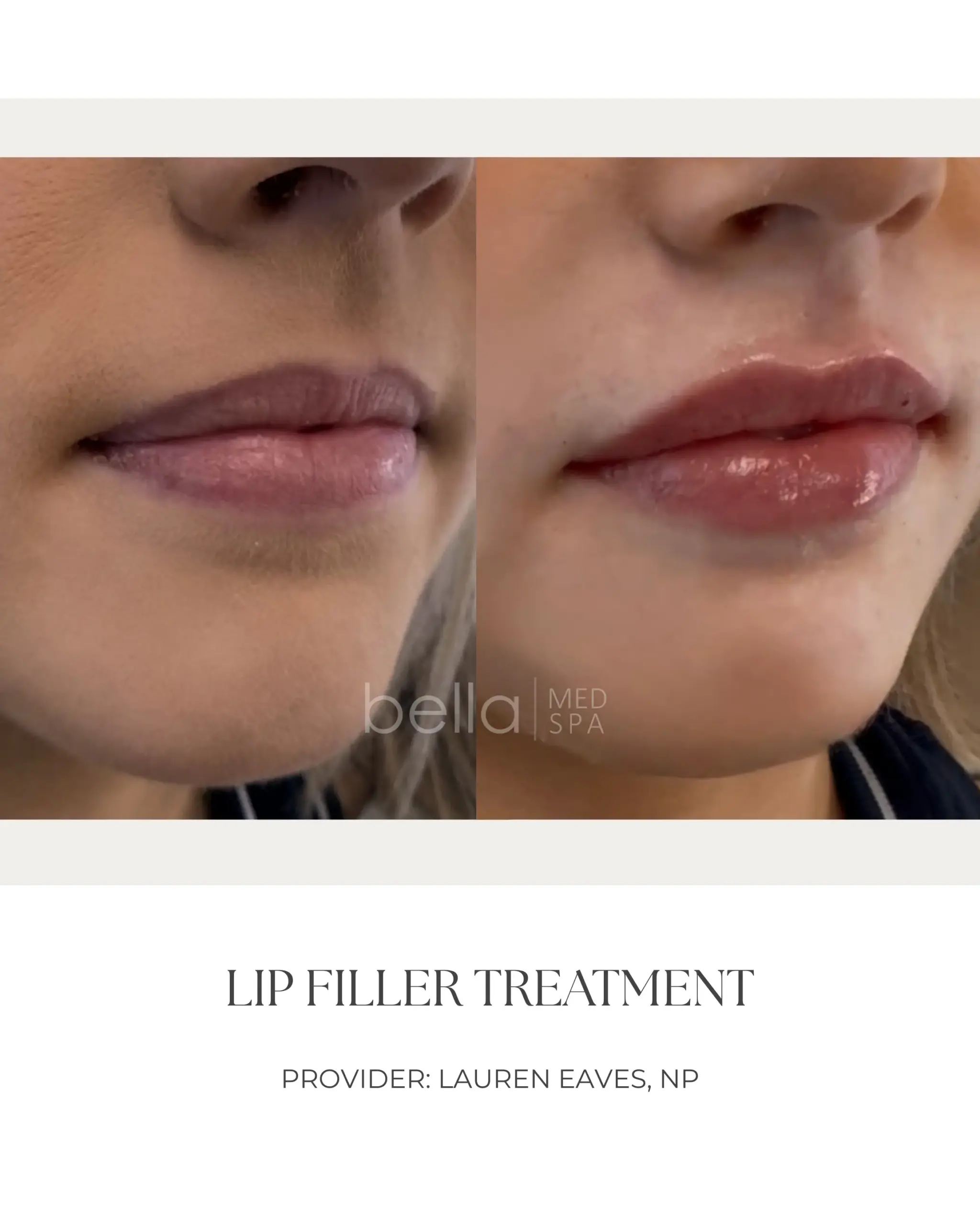 Lip Filler Transformation